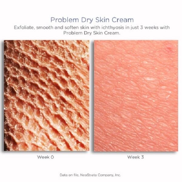 NeoStrata – Resurface Problem Dry Skin Cream